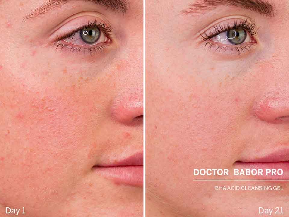 DOCTOR BABOR PRO תכשיר ניקוי בטא הידרוקסי